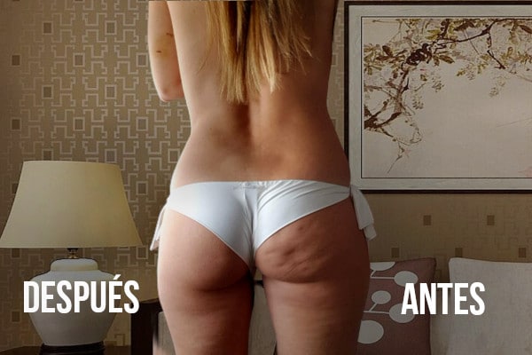 los parches valy quitan la celulitis